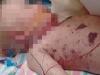 ‘Cruel and ugly’ horror of meningococcal