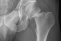 Hip fractures, and other common breaks, are predicted to increase with the ageing population. 