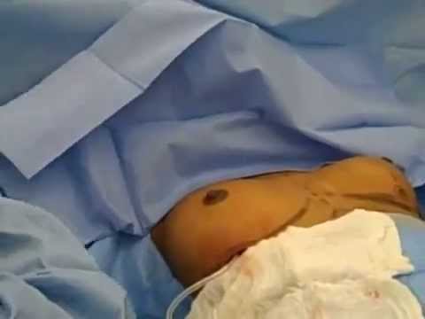 Saline Breast Augmentation