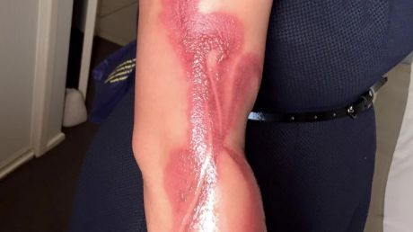 Melanie Tan Pelaez posted a picture online showing burns received after falling asleep on her charging iPhone 7.