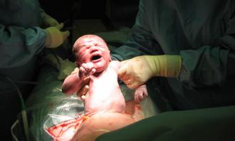 Epidurals for caesarean births