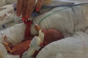 Billie Ava Stevens, weighed just 510 grams when she arrived prematurely.