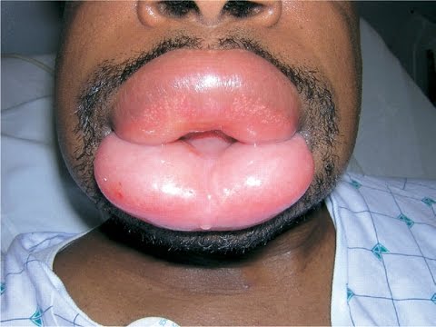 angioedema