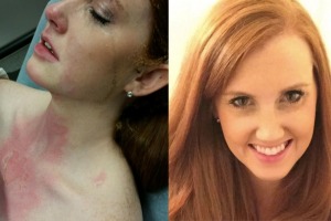Molly Landis after and before the accident. 
