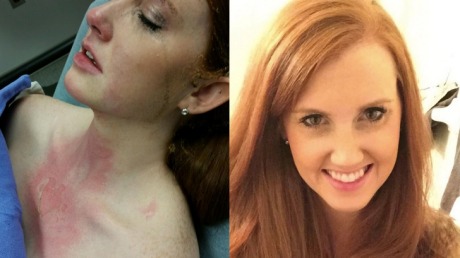 Molly Landis after and before the accident. 