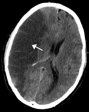 MCA Territory Infarct.svg