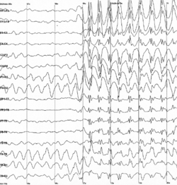 An electroencephalogram of a person with childhood absence epilepsy showing a seizure. The waves are black on a white background.