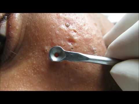 Blackheads on Malar Region