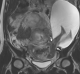 The incredible MRI image shows the rupture (indicated by the white arrows) and the protruding amniotic sac, which ...