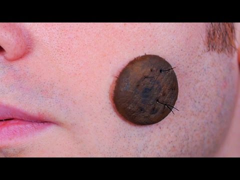 WORLD'S BIGGEST MOLE!