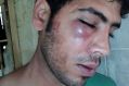 The injuries of two Iranian refugees, allegedly bashed by local authorities on Manus Island.