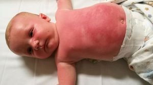 Jessie Swan posted to the Cancer Council Facebook page after her baby was hospitalised for an averse reaction to sunscreen.