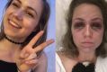 Falls Festival stampede victim 'Maddy' said she still doesn't have white in her eyes 'it's just blood' after she was ...