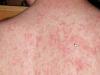 Shoppers warned of measles outbreak