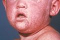 The measles rash on the face of a child.