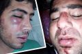 The injuries of two Iranian refugees, allegedly bashed by local authorities on Manus Island. 