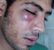 The injuries of two Iranian refugees, allegedly bashed by local authorities on Manus Island. Photo: Supplied