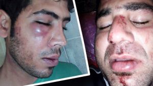 The injuries of two Iranian refugees, Mehdi (left) and Mohammad, allegedly bashed by local authorities on Manus Island.