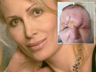 Carol Bryan got facial fillers that went horribly wrong. Picture: Saving Face