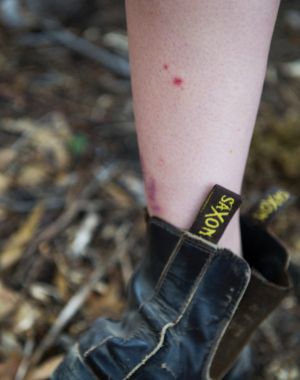 The bite marks of an brown snake on Tayla Ballard.