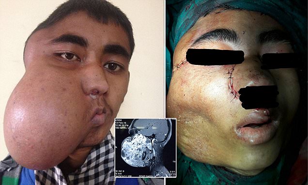 Boy, 17, has a MELON-sized tumour removed from his nose