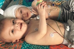 Anias and Jadon McDonald are doing well following separation surgery.