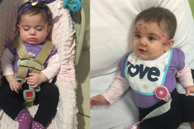 Five-month-old baby Antonella, before and after she was attacked by a friend's cat.