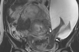The incredible MRI image shows the rupture (indicated by the white arrows) and the protruding amniotic sac, which ...