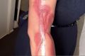 Melanie Tan Pelaez posted a picture online showing burns received after falling asleep on her charging iPhone 7.