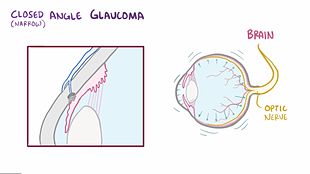 File:Glaucoma.webm