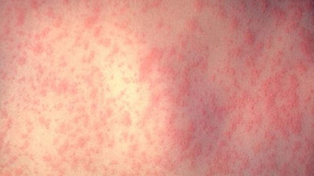 Three children have caught measles after being exposed to a infected child from a non-vaccinating family.