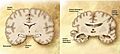 Et diagram over en normal hjerne (venstre) og en Alzheimer-patients hjerne (højre)