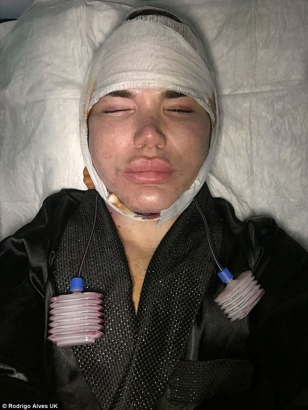 'I can't feel my face': Rodrigo first discussed his 50th plastic surgery operation with MailOnline after having a face, neck and eyelift in one day, just eleven days ago