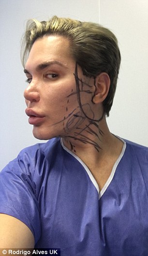 Prep: Lines were inked across Rodrigo's face ahead of the surgeries, showing where alterations were going to be made