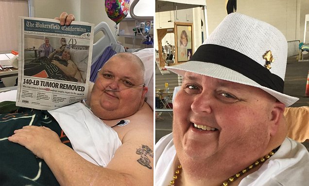 Mississippi man removes 140-POUND tumor from stomach