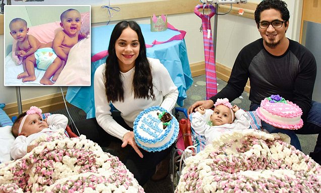 Formerly conjoined twins celebrate their first birthday