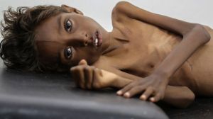 Five-year-old Mohannad Ali lies on a hospital bed in Abs, Yemen, in December. His two-year-old cousin died of hunger.