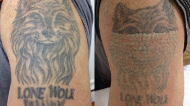 Before and after shots of a tattoo removal at Melbourne Tattoo Removal.