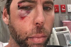 Grant Hackett has posted an image of himself to social media, his face bloody and bruised.