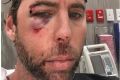 Grant Hackett posted an image of himself to social media on Thursday, his face bloody and bruised.