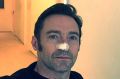 Hugh Jackman had his sixth skin cancer removed from his face.