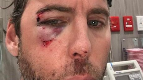 Grant Hackett posted an image of himself to social media on Thursday, his face bloody and bruised.