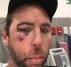 Grant Hackett posted an image of himself to social media on Thursday, his face bloody and bruised.