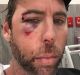 Grant Hackett posted an image of himself to social media on Thursday, his face bloody and bruised.