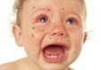 A baby boy with measles.