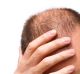 Many miracle cures for hair loss come with a price.