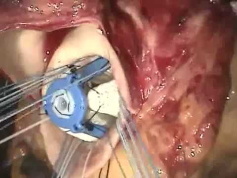 Aortic Valve Replacement:  Operative Technique.  Arie Blitz, MD