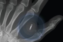 X ray of microchipped hand (Supplied)