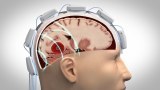 Stroke diagnosis helmet could help doctors save lives, prevent major brain damage: experts