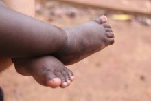 Toddler's feet (ABC News)